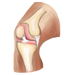 Knee Replacement Surgery